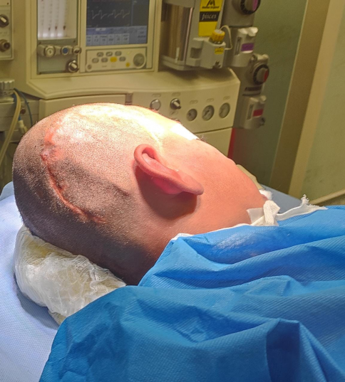 نجاح عملية لطفل أثر سقوط مروحة سقفية على رأسه أدى 