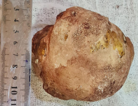نجاح فريق طبي برفع حصاة  تزن 1 كغم  في مدينة الصدر